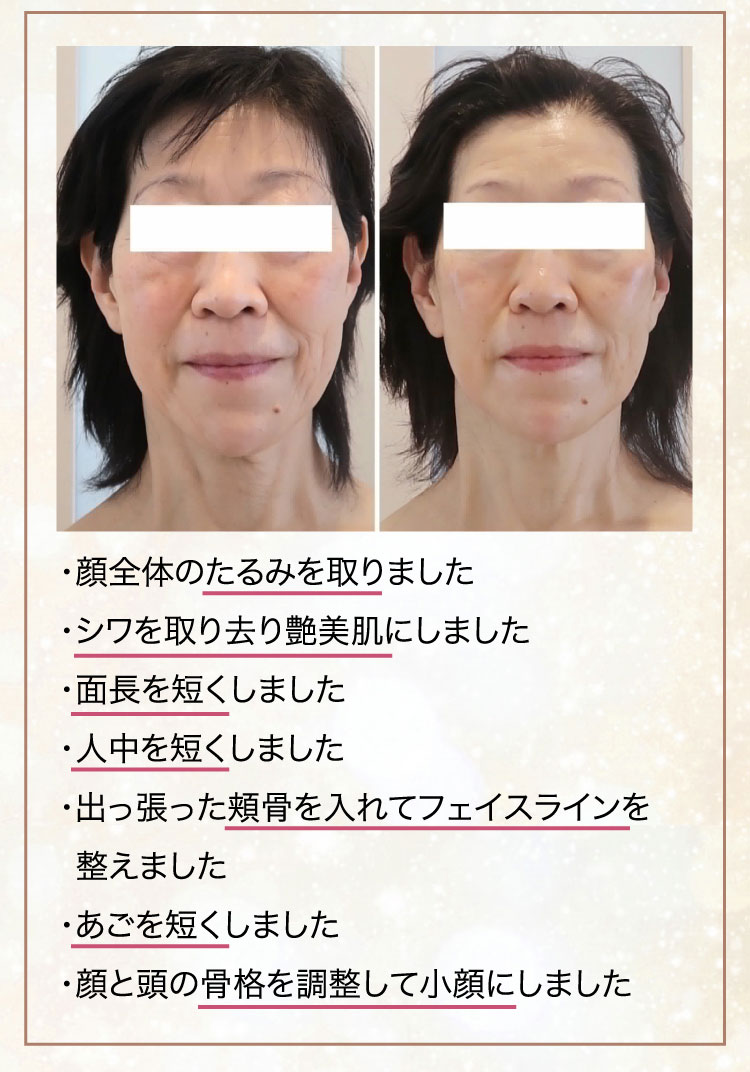 整形級小顔術soimeme